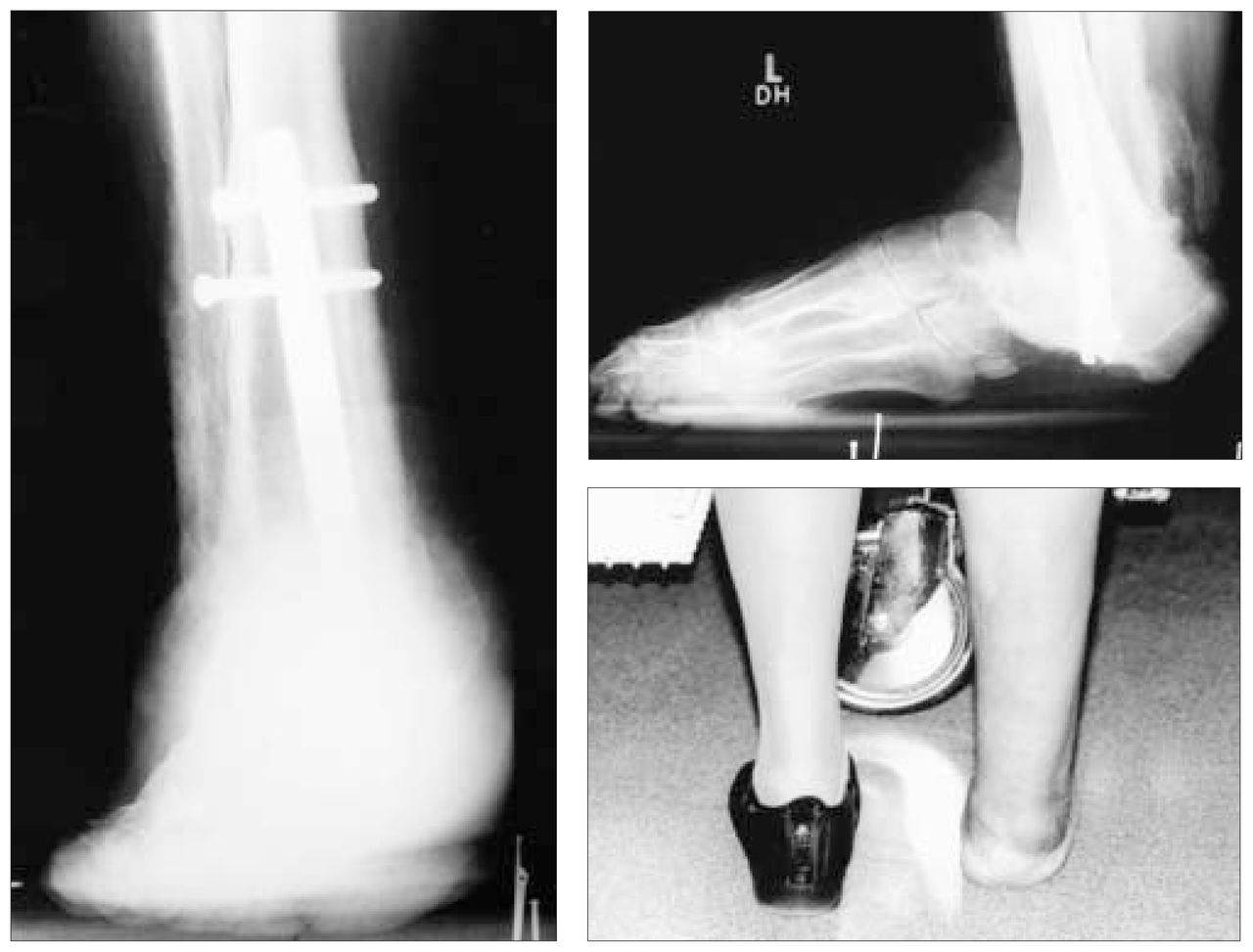 Midfoot and hindfoot arthrodeses in diabetic Charcot arthropathy | CJS